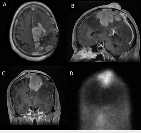 Magnetic Resonance Imaging T1 Weighted Contrast Enhanced Mri Images In