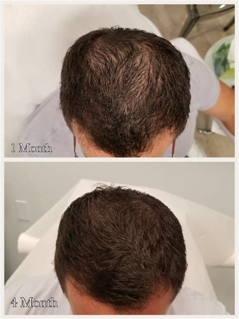 Prp Hair Restoration Before And Afters