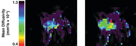 Effect Of Iv Administration Of A Gadolinium Based Contrast Agent On