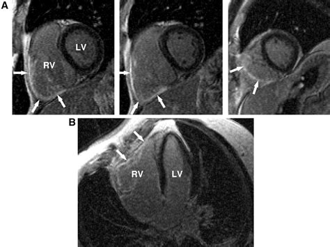 Assessment Of Isolated Right Ventricular Myocardial Infarction By