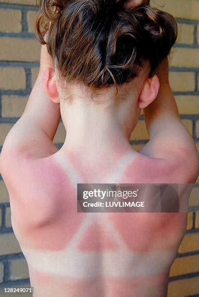 700 Child Sunburn Stock Photos, High-Res Pictures, and Images - Getty ...