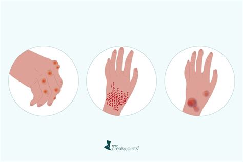 Rheumatoid Arthritis and Skin Problems: What You Need to Know