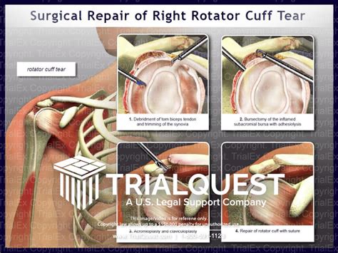 Surgical Repair Of The Right Rotator Cuff Tear Trialexhibits Inc