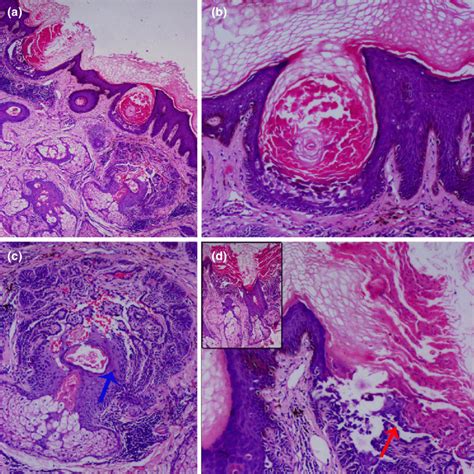 A Acanthotic And Hyperkeratotic Epidermis With Follicular Plugging