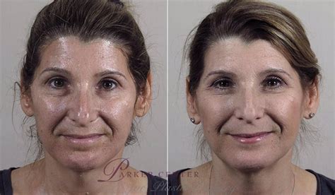 Nonsurgical Face Procedures Before And After Pictures Case 343 Paramus Nj Parker Center For