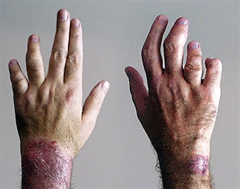 Psoriatic Arthritis Overview