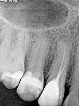 Endodontologie Op Mikroskop Gest Tzte Wurzelkanalbehandlung