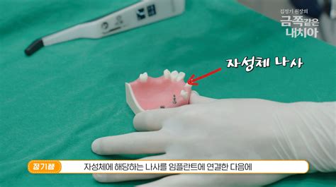 5초만에 임플란트 수명을 가늠할 수 있는 과학적인 방법 김원장 칼럼