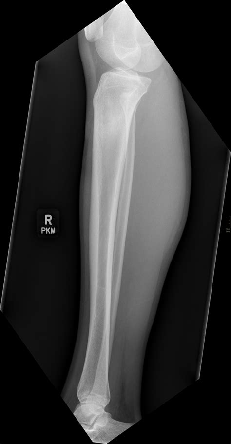 Osteoid Osteoma Image