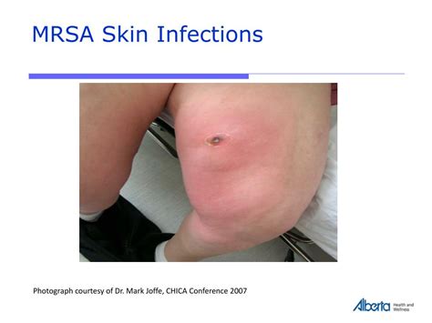 Ppt Provincial Mrsa Infection Prevention And Control Ipc Guidelines And Standards 2008