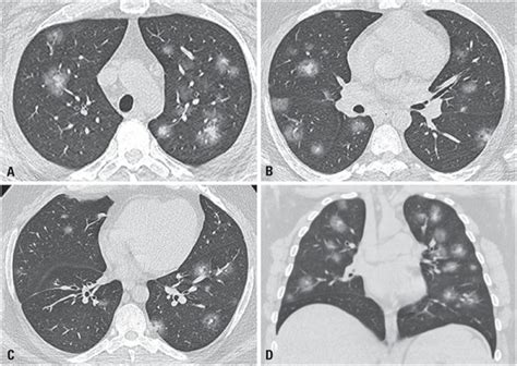 The Halo Sign As A Chest Computed Tomography Finding Of Covid 19