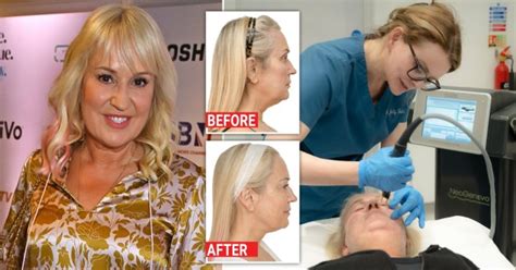 Nicki Chapman Reveals Why She Spent £5000 On A Facelift Metro News