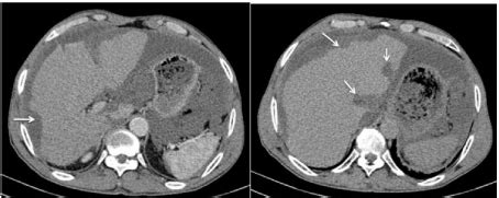 Liver Scalloping An Evocative Sign Of Pseudomyxoma Peritonei