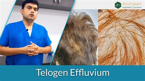 What Is Telogen Effluvium Hair Loss Dr A Saravanan Explaining In