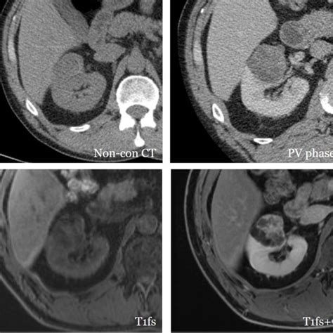 Patient with an incidentally detected, indeterminate left renal lesion ...