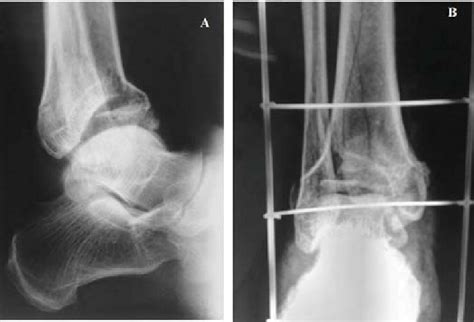 A And B Radiographs Of Distal Tibial Pilon Fracture Aoota Type C