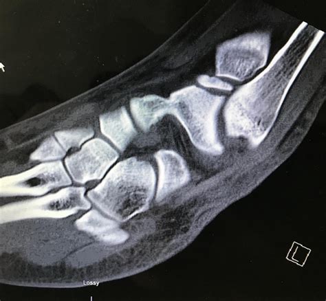 Management Of A Dislocated Talar Dome Fracture With Ankle