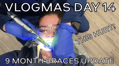 [4k] Vlogmas Day 14 Detailed 9 Month Braces Update Taking Off