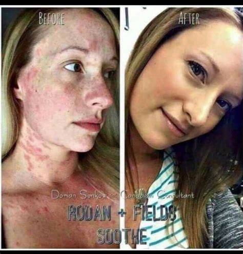 Soothe Redness And Dry Skin Rodan Fields®