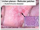 Oral Lichen Planus Flashcards Quizlet