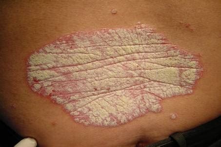 Psoriasis Overview Perri Dermatology