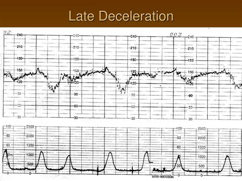 Ppt Electronic Fetal Monitoring Powerpoint Presentation Free Download Id 6639489