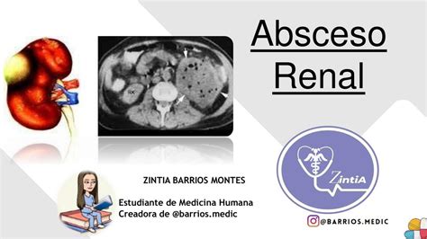 Absceso Renal Barrios Medic Udocz