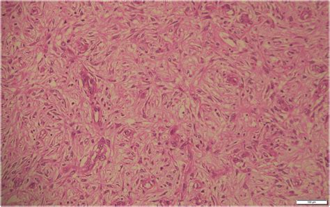 Spindle Shaped Tumor Cells Having Eosinophilic Cytoplasm And Elongated