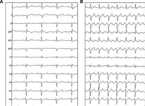 Twelve Lead Electrocardiogram Showing A A Sinus Rhythm After Left