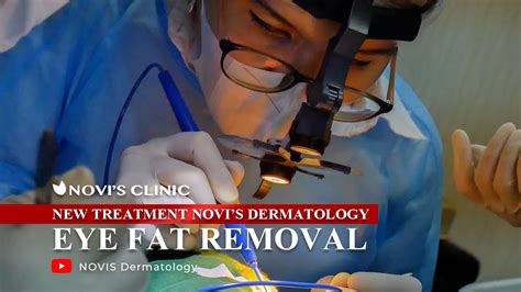 EYE FAT REMOVAL MENGHILANGKAN LEMAK PADA KANTUNG MATA By Dr Novi