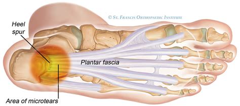 Plantar Fascitiis Heel Pain Causes Treatments Elite Podiatry