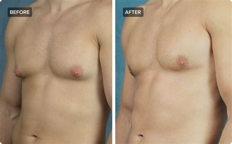 Gynecomastia In Adilabad Causes Treatment And Support