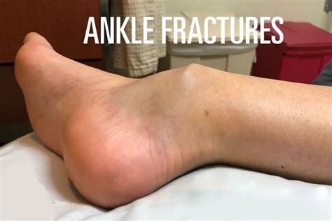 Broken Ankle Symptoms Causes Treatment By Broken Ankle Braces