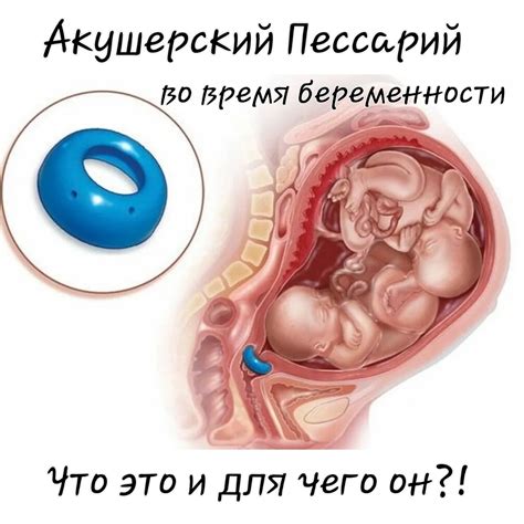 Акушерский пессарий. Ответы на вопросы,которые тревожат будущих мам ...