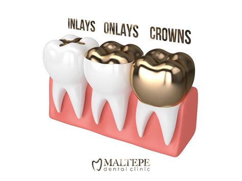 Transform Your Smile With Porcelain Inlays And Onlays Benefits And