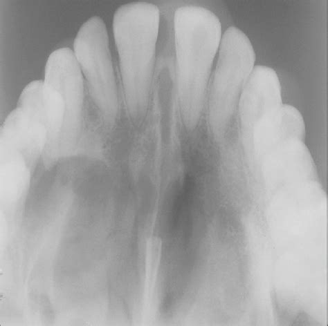 Preoperative True Maxillary Occlusal Radiograph Showing Well Download Scientific Diagram