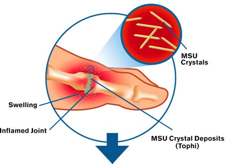 Gout Flare Prevention | Mitigare