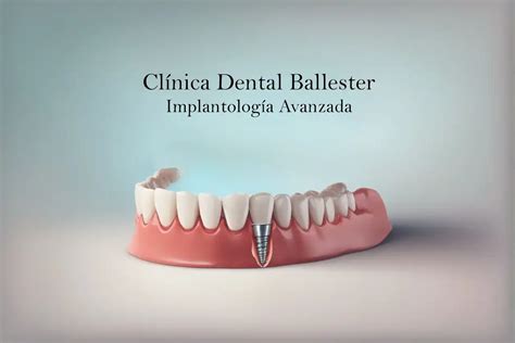 Implantes dentales en Viladecans Clínica Dental Ballester