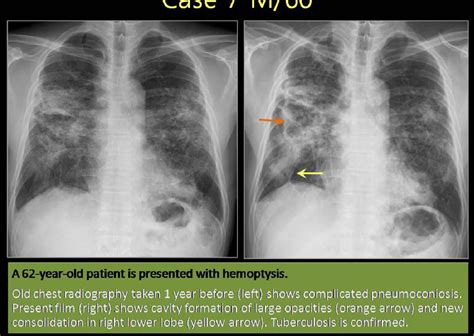 Pneumonia Chest X Ray Findings Peaklua