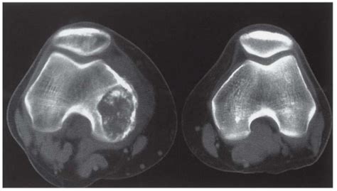 Benign Chondroblastoma Musculoskeletal Key