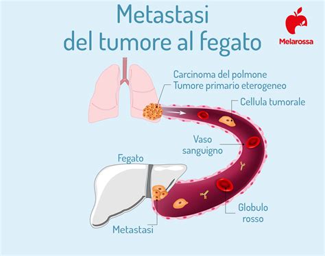 Tumore Al Fegato Cos Sintomi Cause Diagnosi E Cure E Come Prevenire