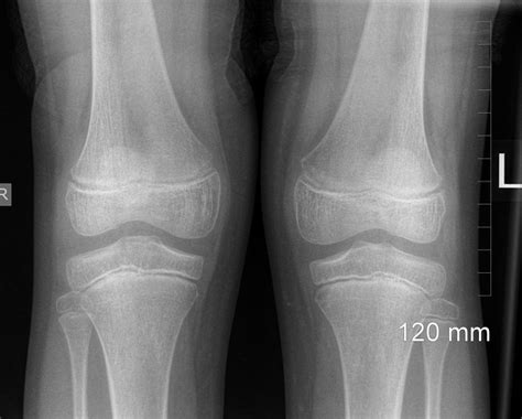 X Ray Knee