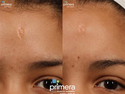 Fraxel® Laser Treatment For Orlando And Winter Park Fl Primera Plastic