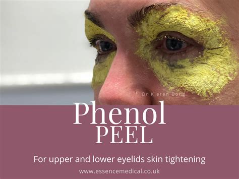 What Is A Phenol Face Peel Essence Medical Cosmetic Clinic