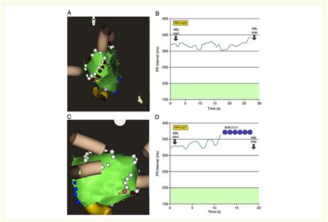 A And C Electro Anatomical Maps Of The Left Atrium At The Th And