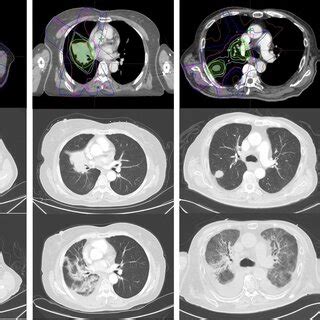 Cumulative Incidence Of Treatmentrelated Pneumonitis By Grade