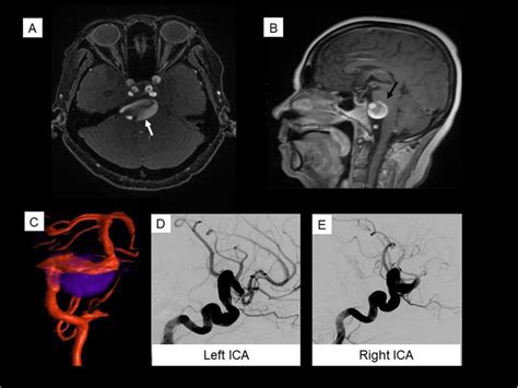 Case 3 Giant Vertebrobasilar Aneurysm Gadolinium Enhanced Mr