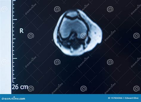 Knee injury mri mcl tear stock photo. Image of orthopedic - 157834366