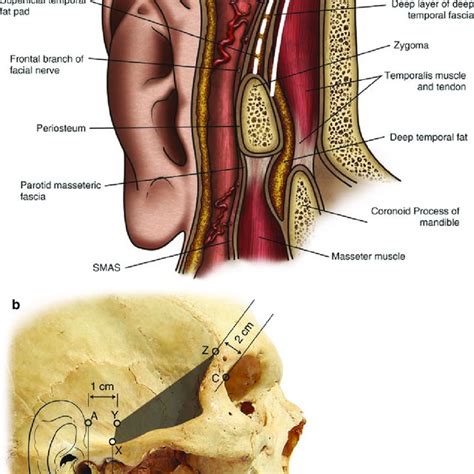 Scalp Flap A Layers Of The Scalp In The Temporal Region Dotted