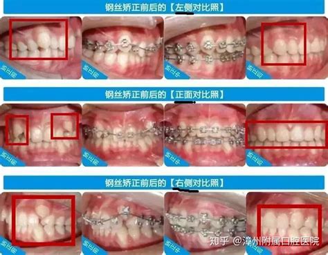 钢丝矫正和隐形矫正哪个效果好性价比高呢 知乎